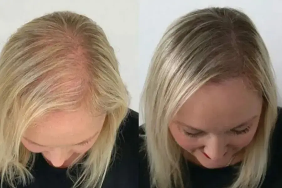 trihopigmentacziya 01