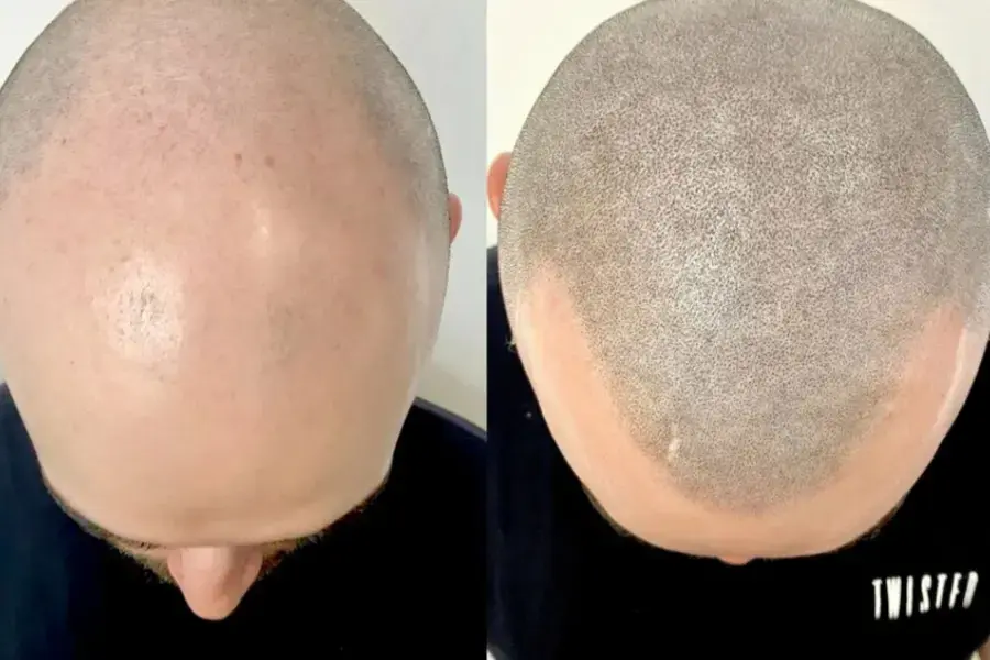 trihopigmentacziya 02