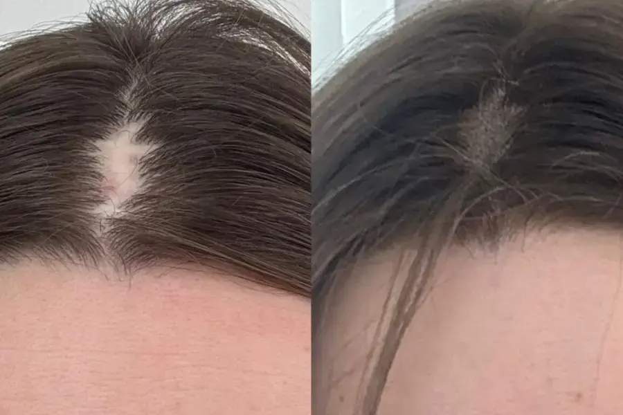 trihopigmentacziya 03