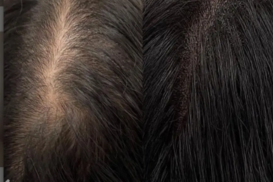 trihopigmentacziya 4